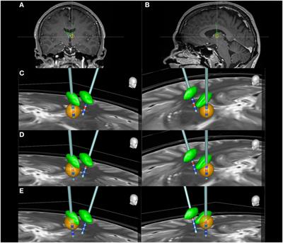 Stimulation Induced Electrographic Seizures in Deep Brain Stimulation of the Anterior Nucleus of the Thalamus Do Not Preclude a Subsequent Favorable Treatment Response